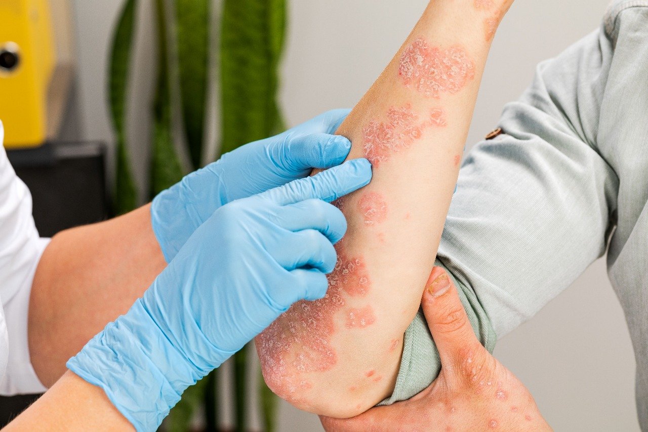 ¿La picazón en la piel es un signo de cáncer?